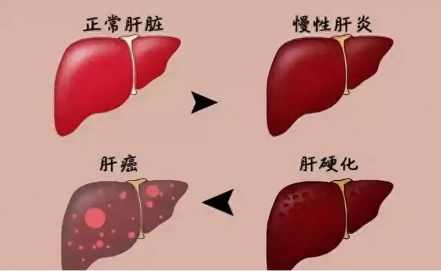 停止饮用1“茶叶”，或比烟酒还伤肝，建议早处理